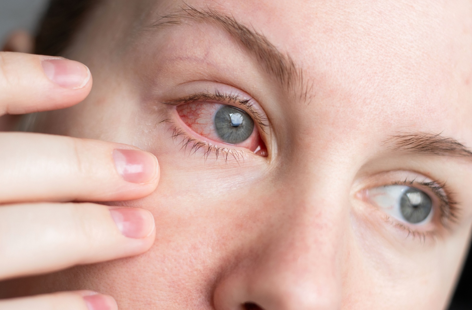 Close-up of a person gently pulling down their lower eyelid who has pink eye.