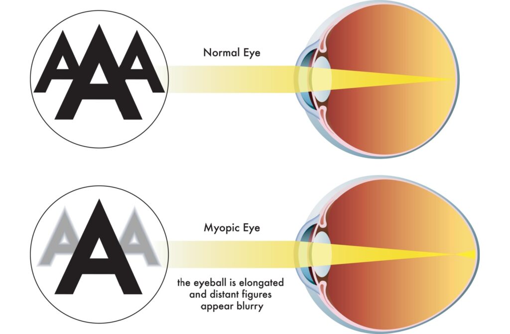 Educational diagram comparing a normal eye and a myopic eye, showing how an elongated eyeball causes blurred distance vision in myopia.
